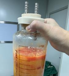 海宁水动力吸脂手术要做多久？